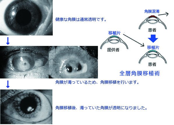 角膜移植について