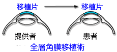 全層角膜移植術